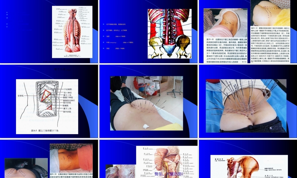 2022年医学专题—密集型压痛点银质针针刺疗法(1).ppt