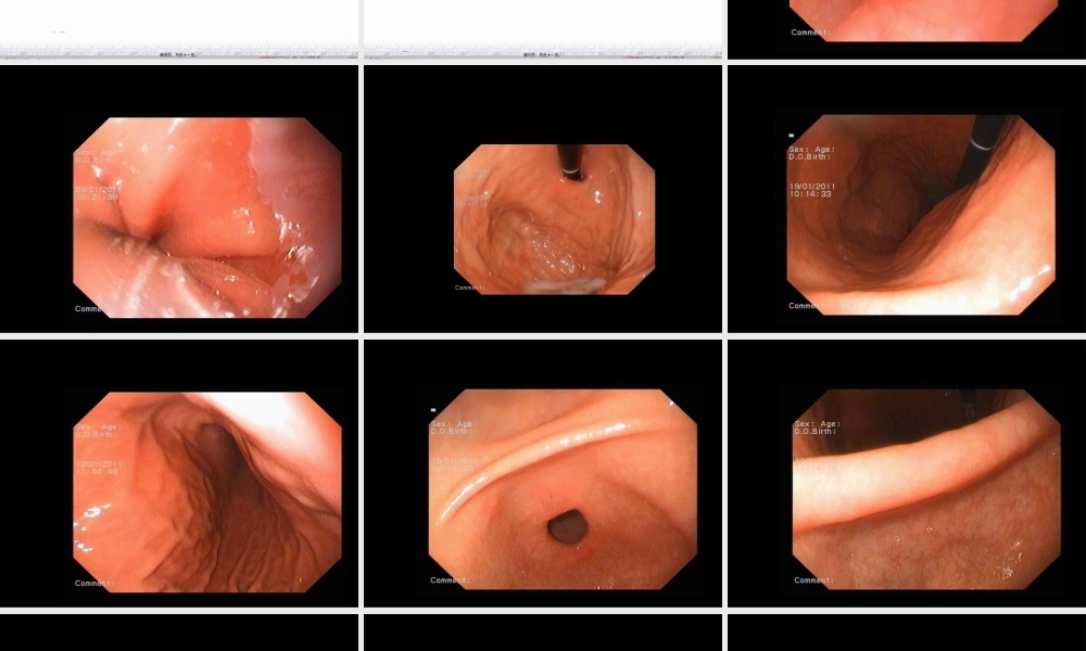 2022年医学专题—常见消化内镜的诊治(1).ppt