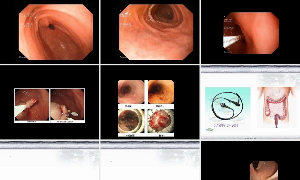 2022年医学专题—常见消化内镜的诊治(1).ppt