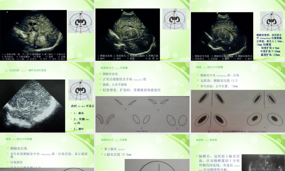 2022年医学专题—新生儿颅脑超声(1).ppt