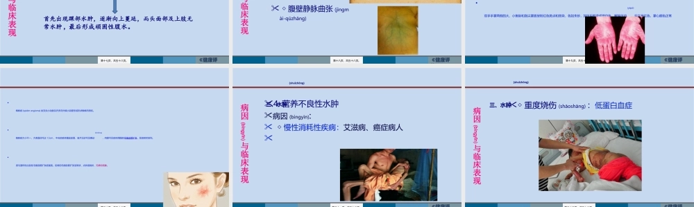 2022年医学专题—水肿脱水新(1).ppt