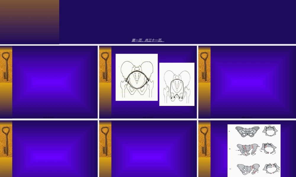 2022年医学专题—第65讲-骨盆骨折重点(1).ppt