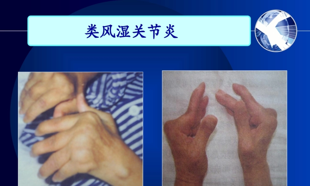 2022年医学专题—第三节-类风湿性关节炎(1).ppt