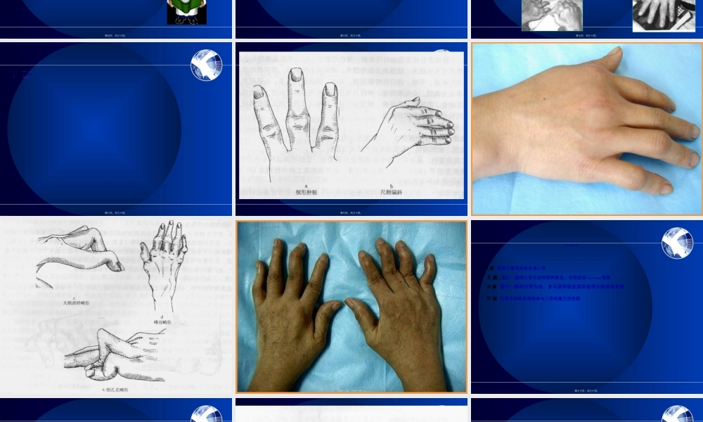 2022年医学专题—第三节-类风湿性关节炎(1).ppt