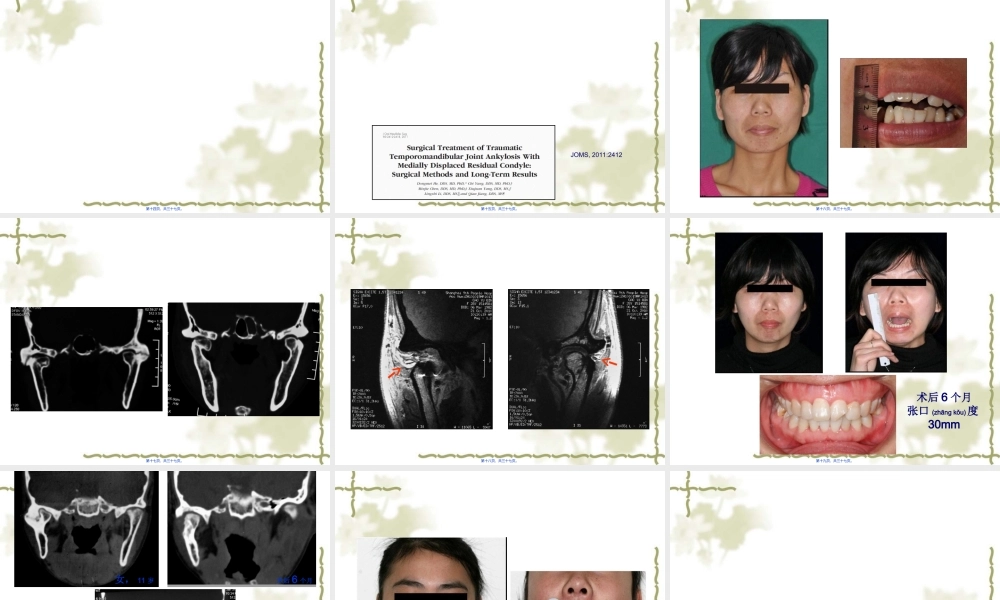 2022年医学专题—第四节-杨驰-颞下颌关节强直的诊治经验(1).ppt