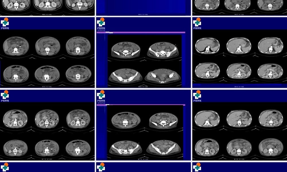 2022年医学专题—系统性红斑狼疮病例(1).ppt