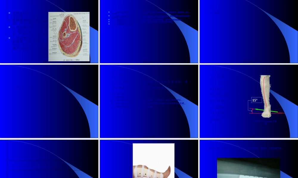 2022年医学专题—胫腓骨干骨折-红软基地(1).ppt