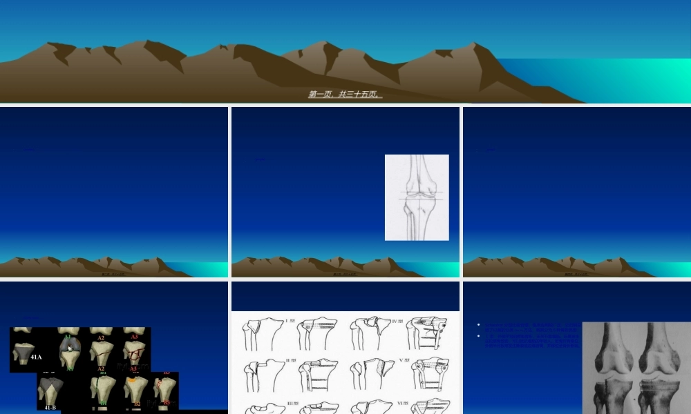 2022年医学专题—胫骨平台骨折(1).ppt