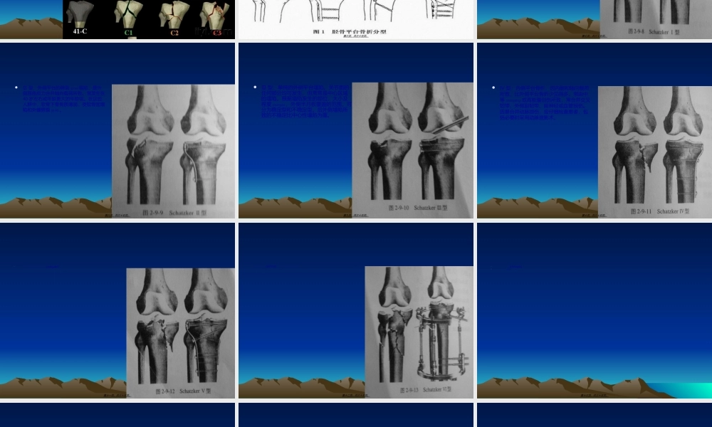 2022年医学专题—胫骨平台骨折(1).ppt