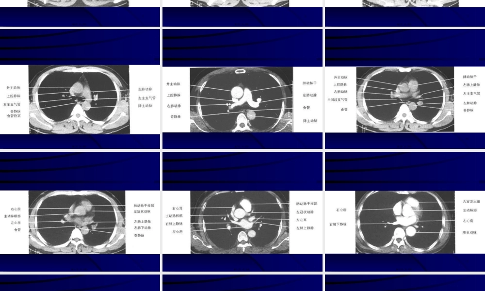 2022年医学专题—正常胸部CT(1).ppt