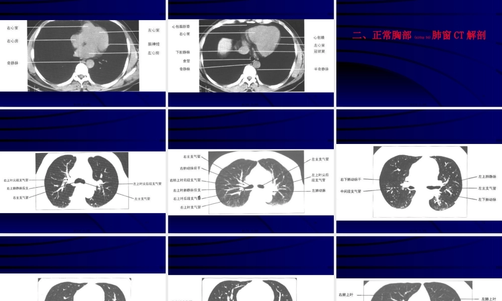2022年医学专题—正常胸部CT(1).ppt