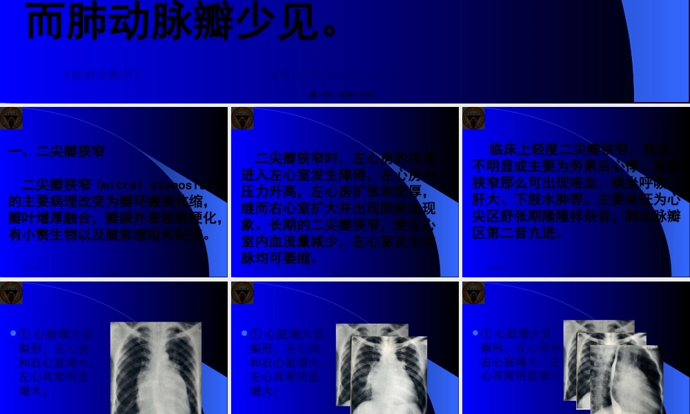 二尖瓣狭窄心脏增大呈梨形左心房和右心室增大肺淤血.pptx