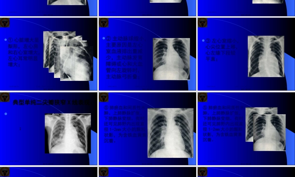 二尖瓣狭窄心脏增大呈梨形左心房和右心室增大肺淤血.pptx