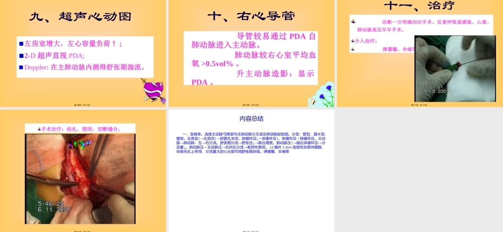 先天性心脏病PDA.pptx