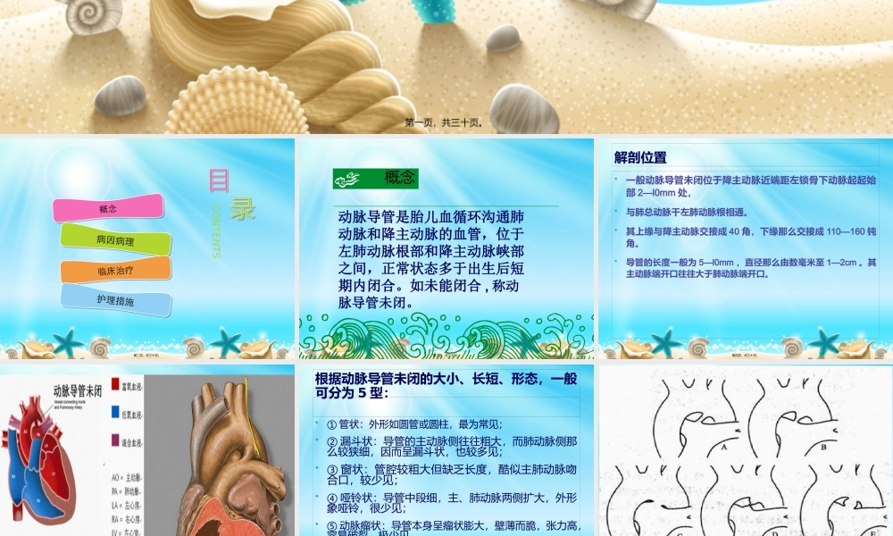 动脉导管未闭9.pptx