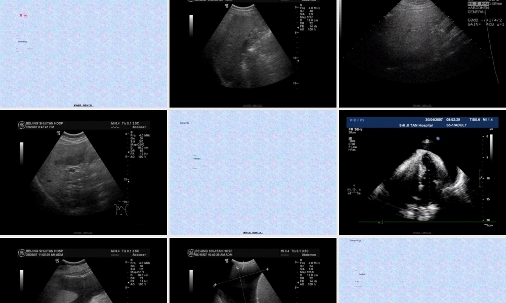 2022年医学专题—住院医师规培结业-腹部超声判读.ppt