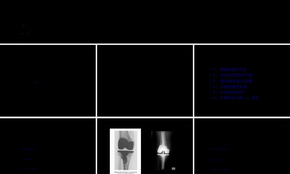 2022年医学专题—DePuy全膝关节置换手术-0(1).ppt