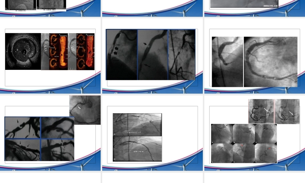 2022年医学专题—冠状动脉病变类型.ppt