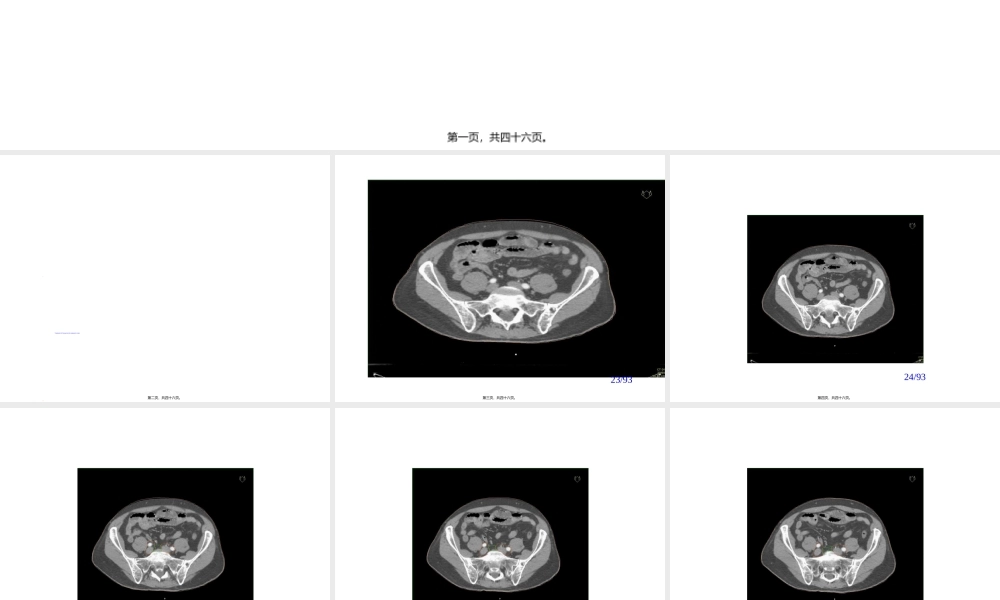 2022年医学专题—前列腺癌淋巴结及靶区勾画.ppt