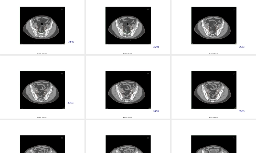 2022年医学专题—前列腺癌淋巴结及靶区勾画.ppt