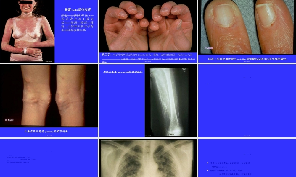 2022年医学专题—多发性肌炎&皮肌炎.ppt