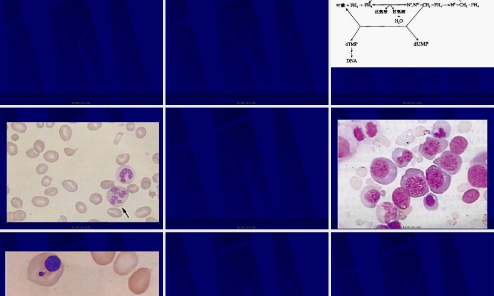 2022年医学专题—巨幼细胞贫血-同济医院血液科-梁爱斌.ppt