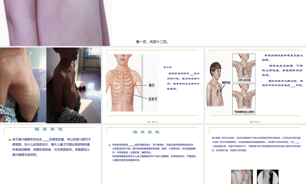 2022年医学专题—漏斗胸-ppt.ppt