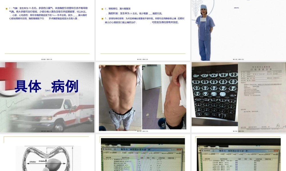 2022年医学专题—漏斗胸-ppt.ppt