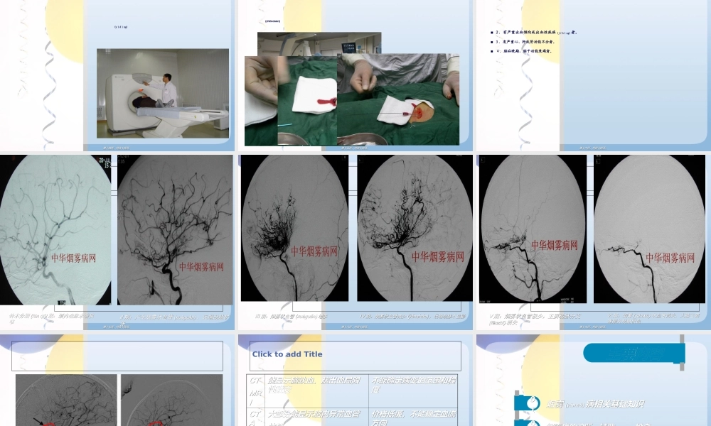 2022年医学专题—烟雾病.ppt