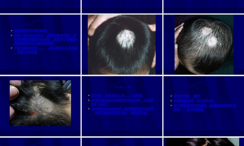 2022年医学专题—真菌性皮肤病分析.ppt