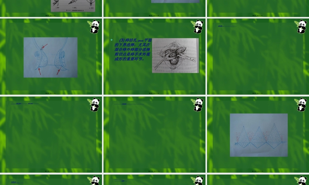 2022年医学专题—痔结扎注射术--二龙路医院--董平教授.ppt