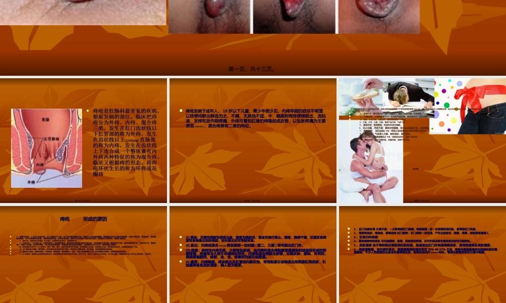 2022年医学专题—痔疮.ppt