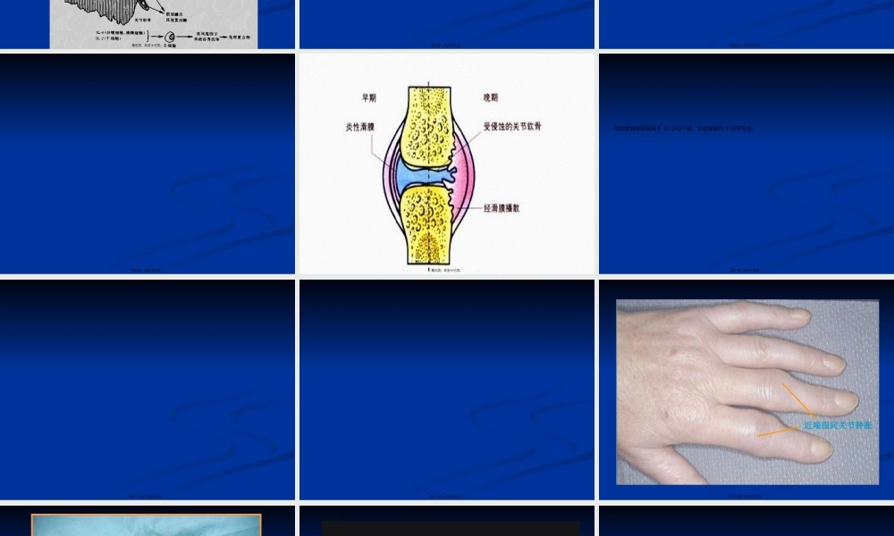 2022年医学专题—第二章--类风湿关节炎(1).ppt