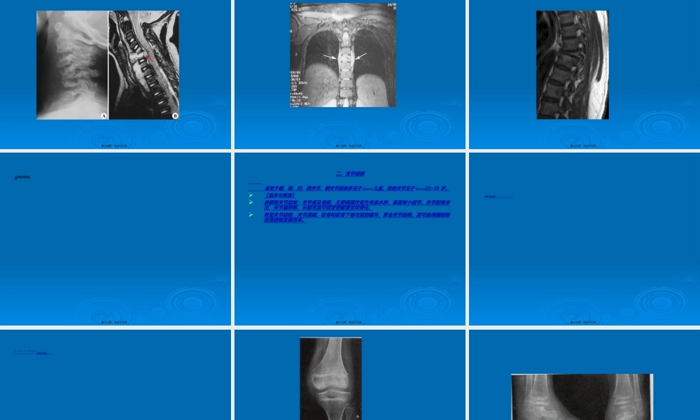 2022年医学专题—第九节：骨关节结核(1).ppt