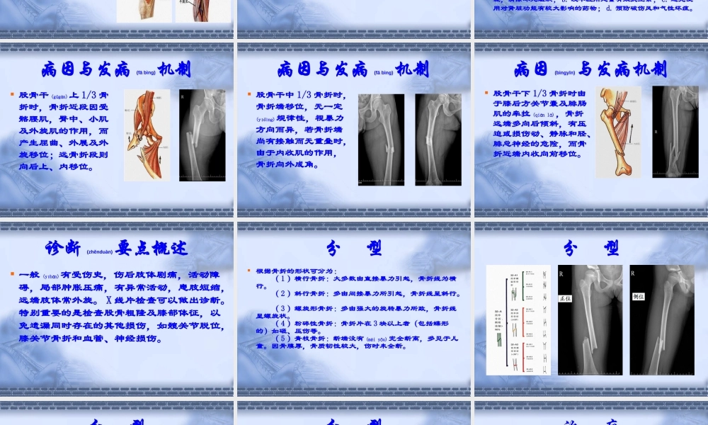 2022年医学专题—股骨干骨折.ppt