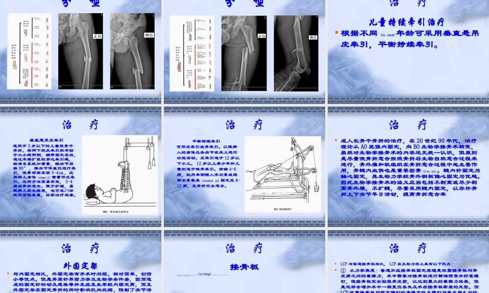 2022年医学专题—股骨干骨折.ppt
