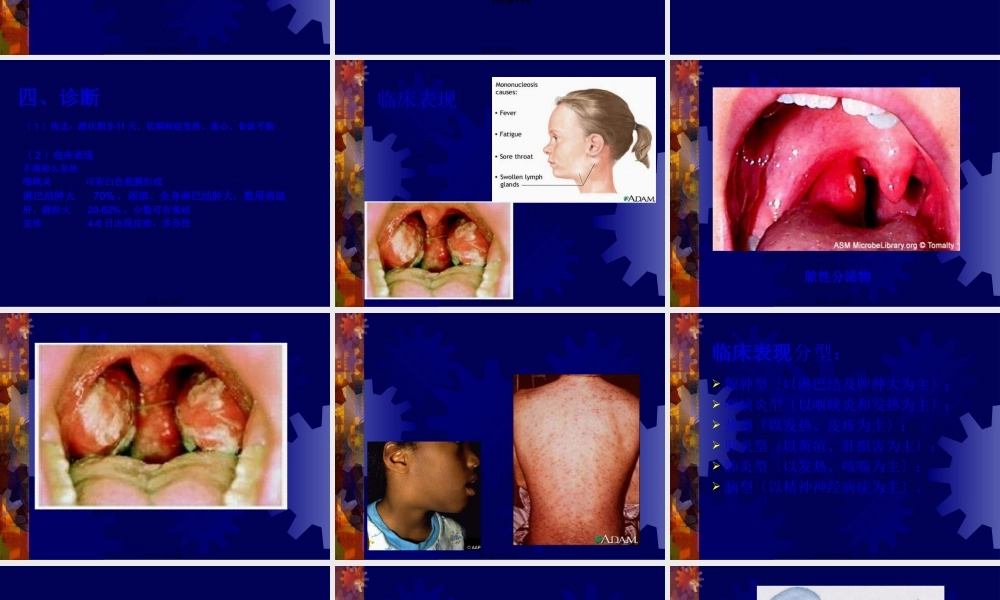 传染性单核细胞增多症2012级.pptx