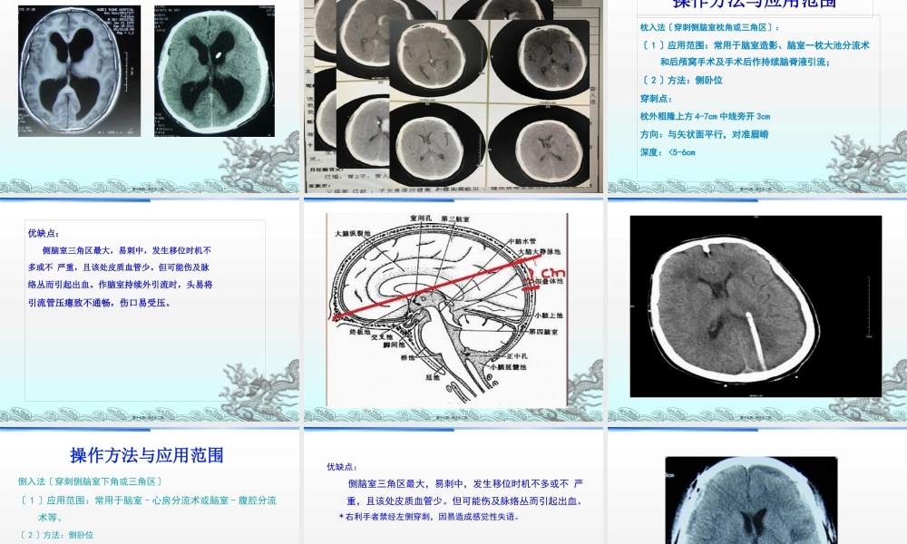 侧脑室穿刺术及脑脊液引流.pptx