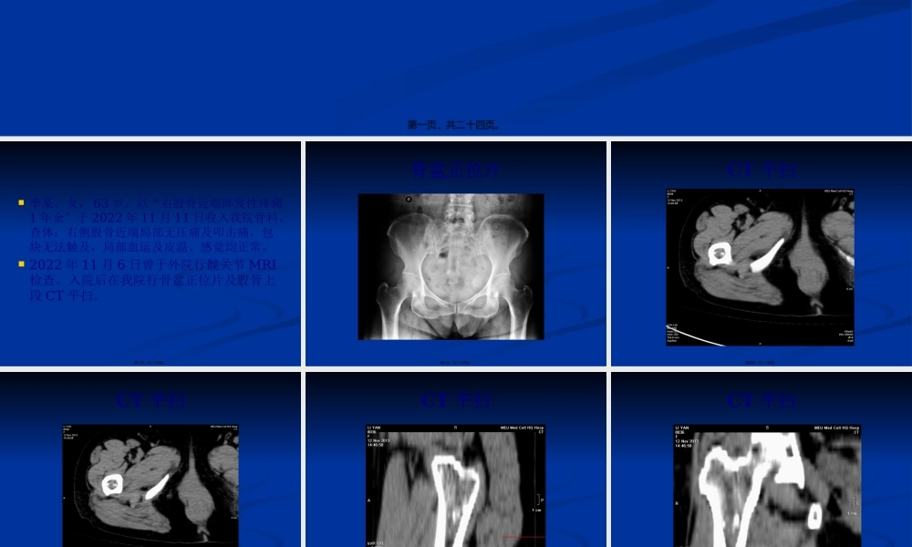 内生性骨软骨瘤.pptx