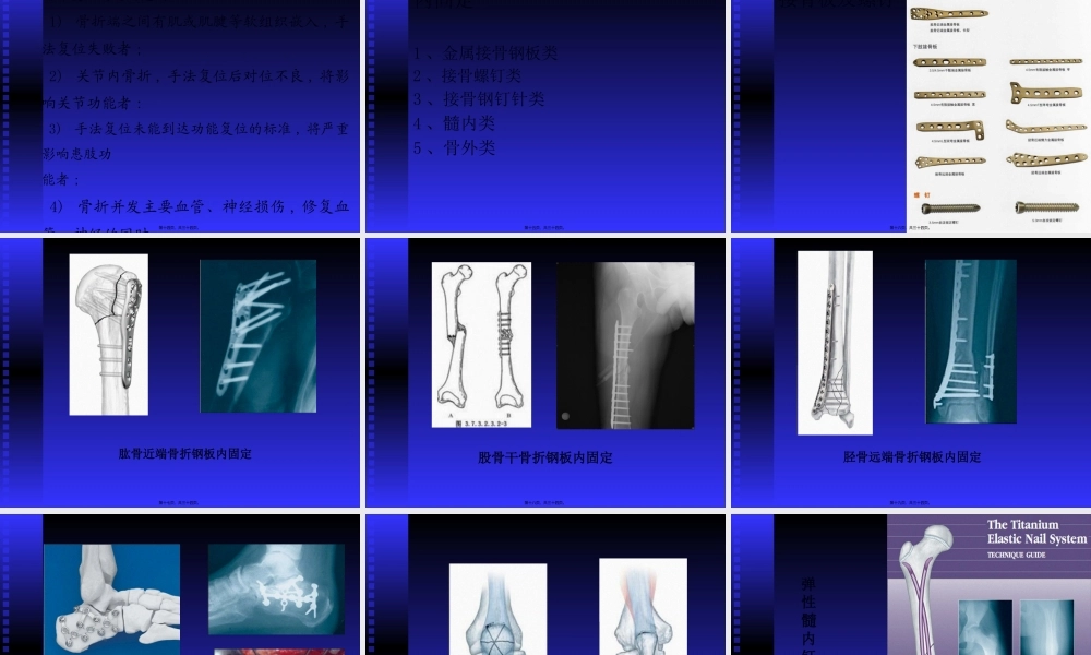 创伤骨科基础知识及常见手术方式.pptx