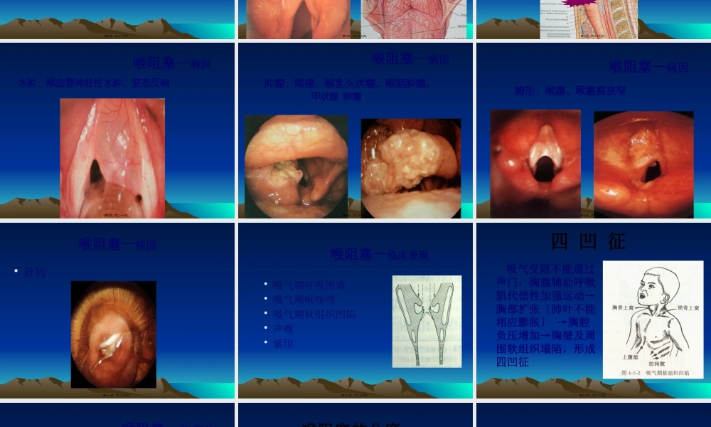 喉梗阻及气管切开.pptx