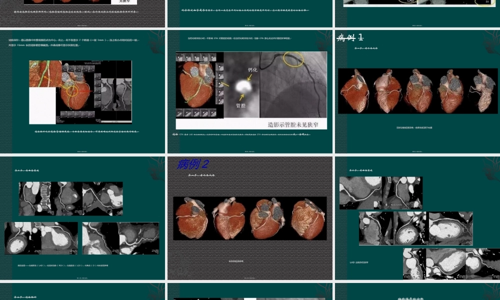 如何看冠脉CTA.ppt