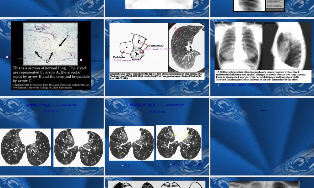 2022年医学专题—呼吸系统基本病变的影像学表现.ppt
