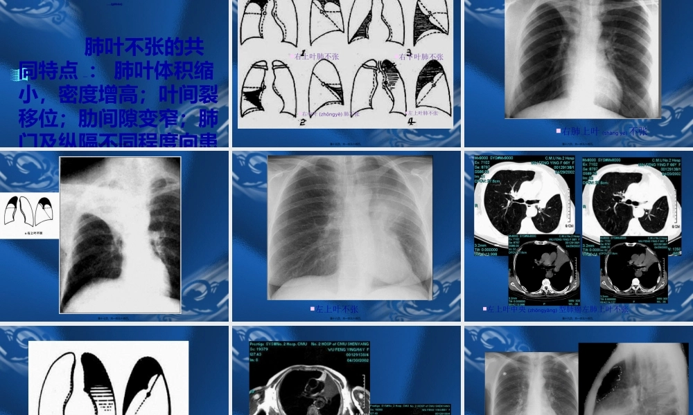 2022年医学专题—呼吸系统基本病变的影像学表现.ppt