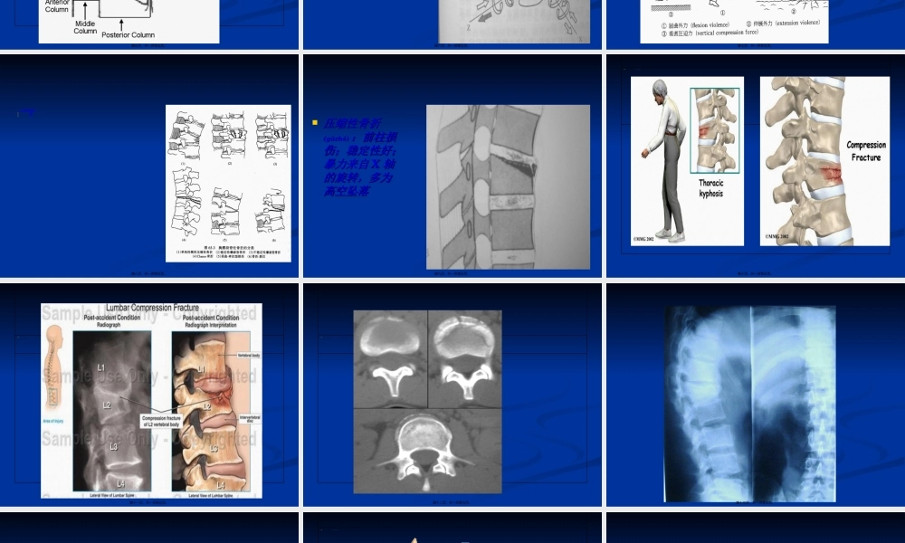 2022年医学专题—脊柱和骨盆骨折骨折.ppt