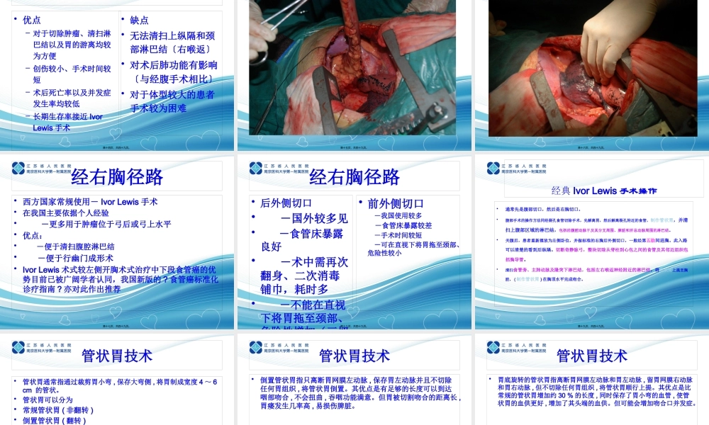 传统的食管外科术式——Ivor-Lewis.pptx