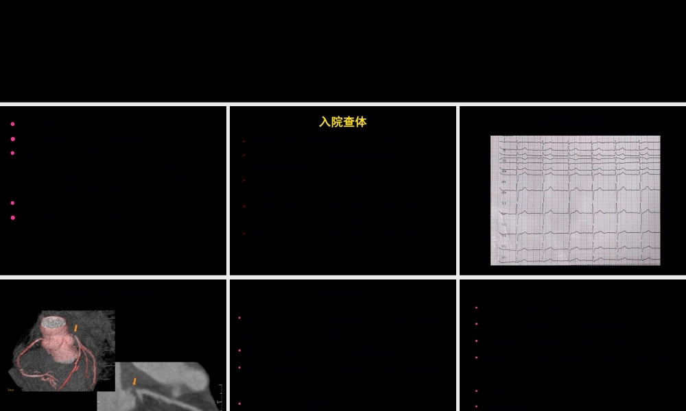 大动脉炎合并冠状动脉狭窄.pptx