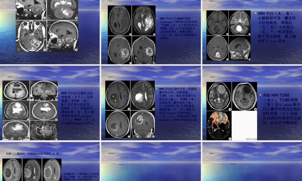 2022年医学专题—星形细胞瘤(1).ppt