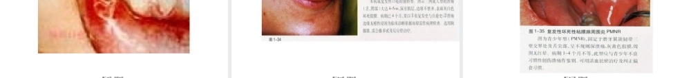 2022年医学专题—口腔粘膜病复发性阿弗他溃疡(1).ppt