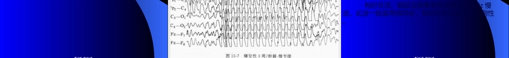2022年医学专题—癫痫的脑电图(1).ppt